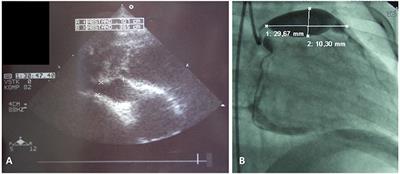 Kawasaki Disease